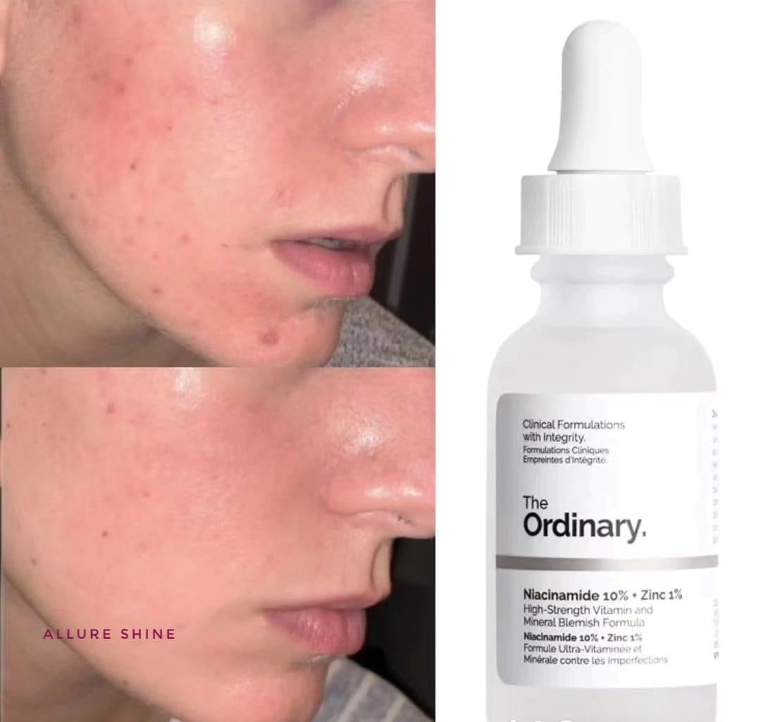 The Ordinary Niacinamide 10%+ Zinc 1% Serum 30mL